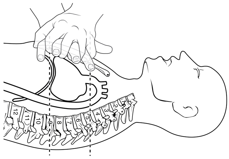 CPR hands placement: push fast and hard on the sternum two times per second | Illustration: Creative Commons