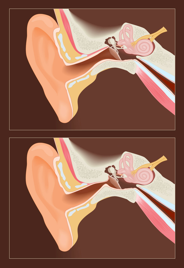 Exostosis: an healthy ear canal (above), and a Surfer's Ear (below) | Illustration: Shutterstock