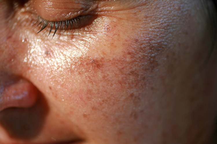 Hyperpigmentation: excessive sun exposure leads to the development of darker skin areas | Photo: Louis Widmer