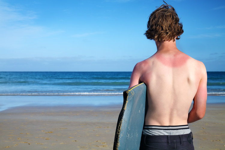 Sunburn: protect your surfer skin by applying SPF 30 plus sunscreen | Photo: Shutterstock