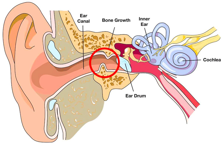 Surfer's Ear: a benign bone growth under the skin of outer ear canal